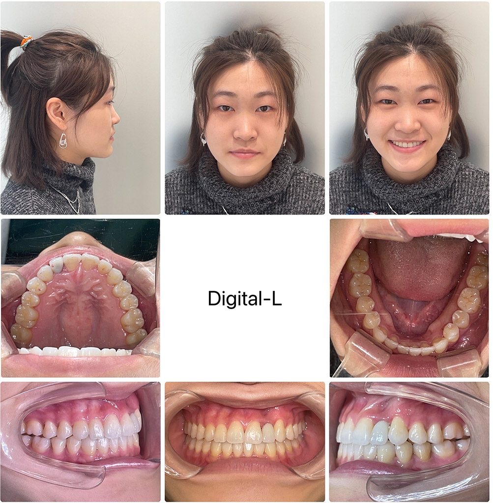 症例１	増歯矯正：口元の凹みの改善（17ヶ月）