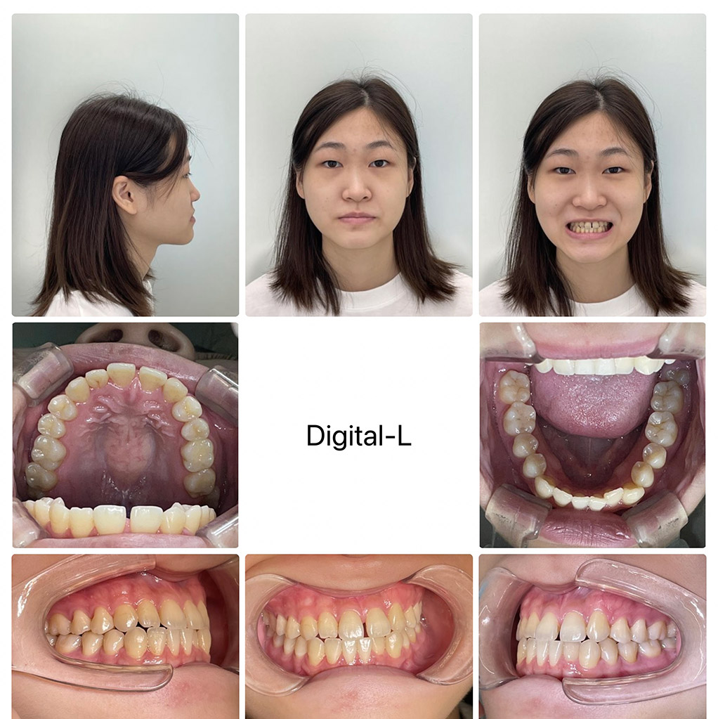 症例１	増歯矯正：口元の凹みの改善（17ヶ月）