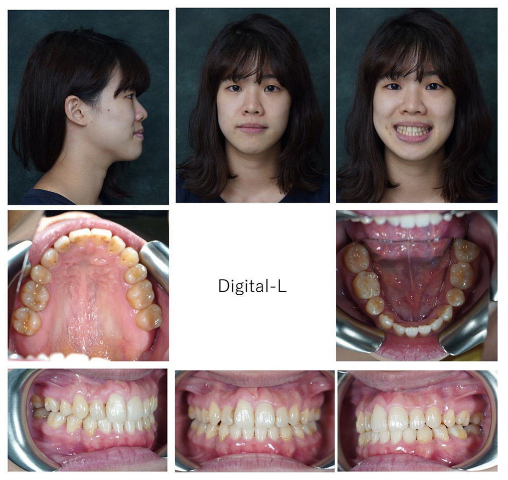 症例２	抜歯矯正：出っ歯、ガタガタと口元の改善（14ヶ月）
