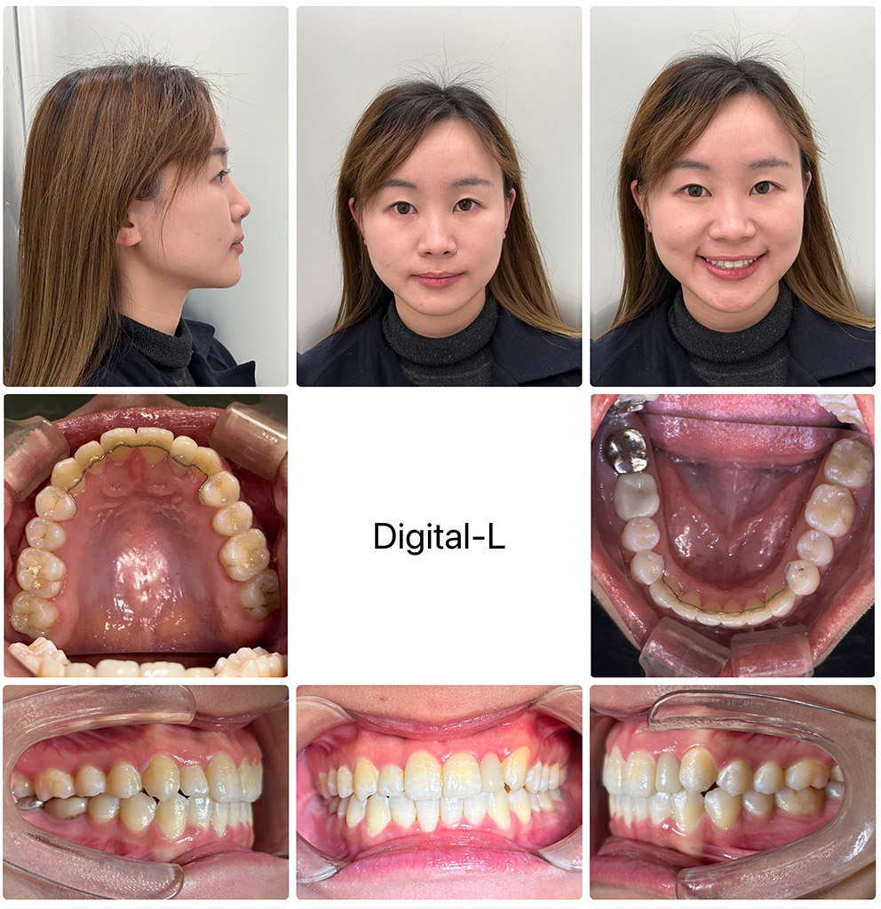 症例３	非抜歯矯正で口元の形とスマイルラインの改善