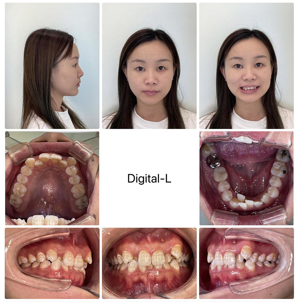 症例３	非抜歯矯正で口元の形とスマイルラインの改善