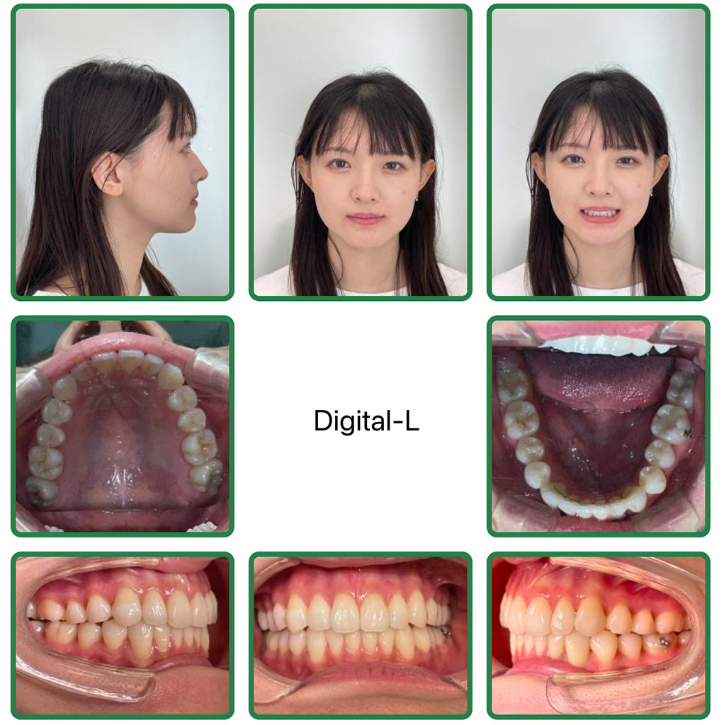 症例４	非抜歯矯正で口元の形とスマイルラインの改善