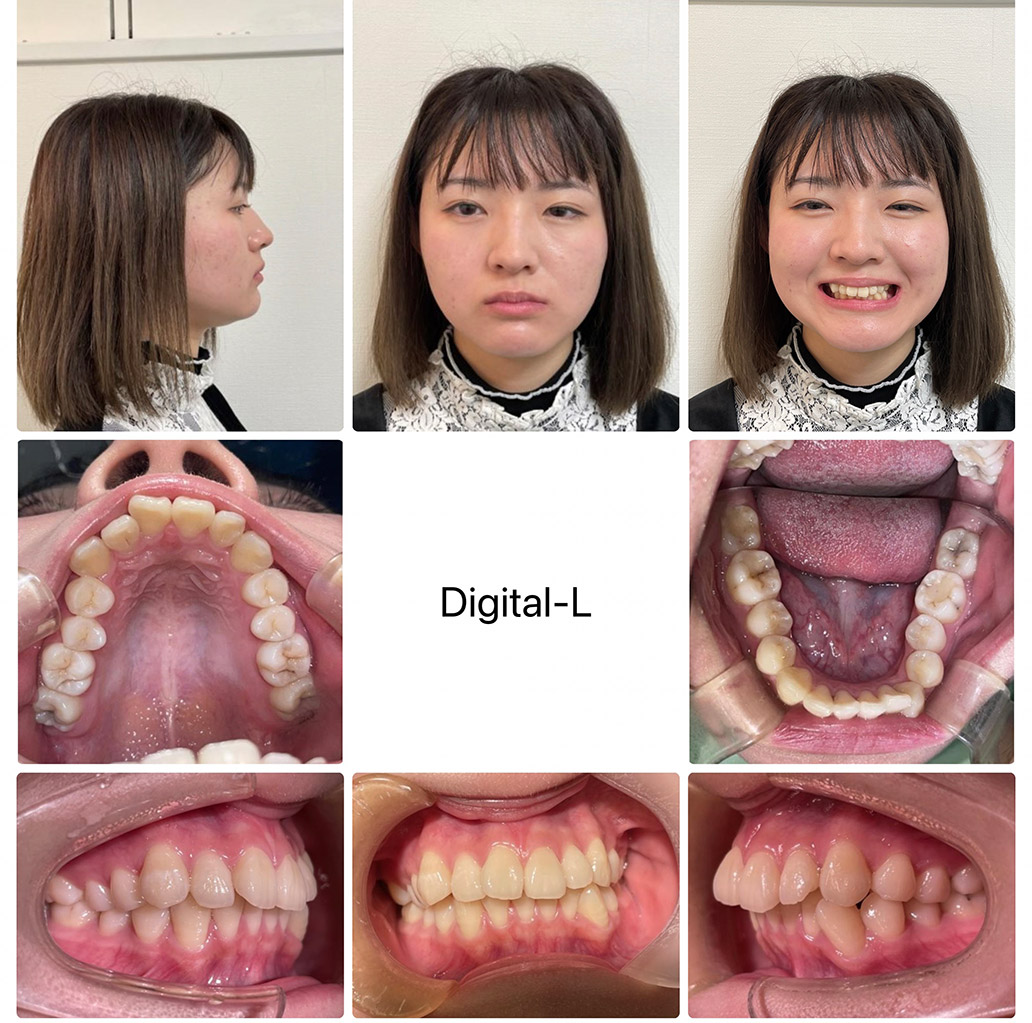 症例４	非抜歯矯正で口元の形とスマイルラインの改善