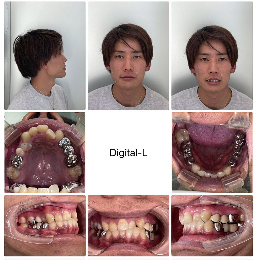 症例５	インビザラインー非抜歯矯正+ セラミック