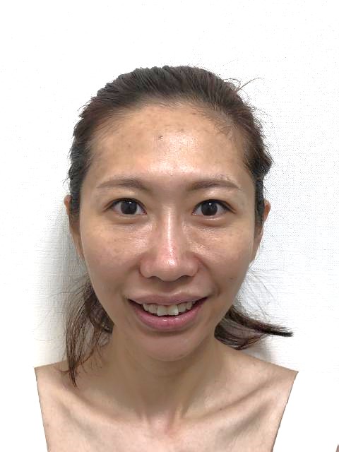 口元の形と歯の色の改善