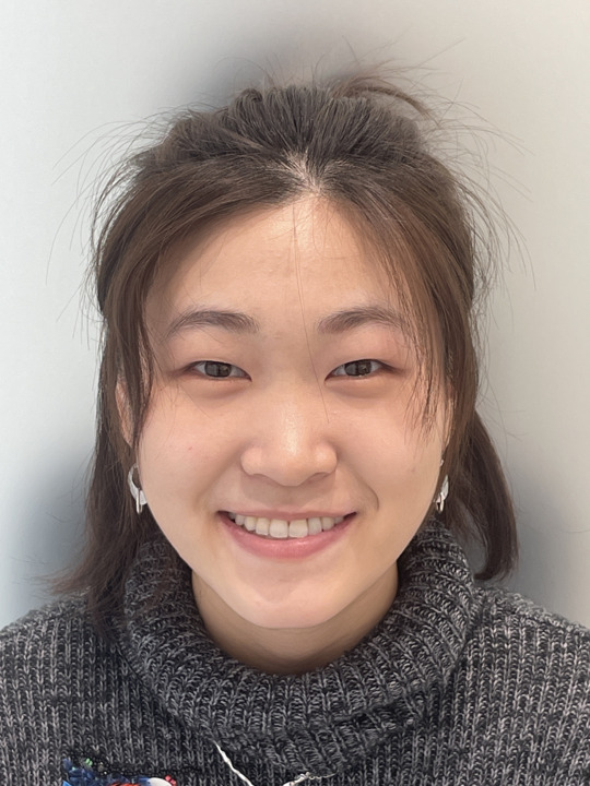 増歯矯正：口元の凹みの改善（17ヶ月）