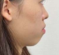 口元のインビザライン抜歯矯正（24ヶ月）