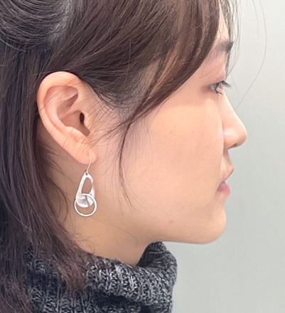増歯矯正：口元の凹みの改善（17ヶ月）