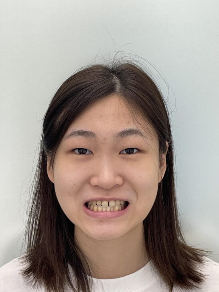 増歯矯正：口元の凹みの改善（17ヶ月）