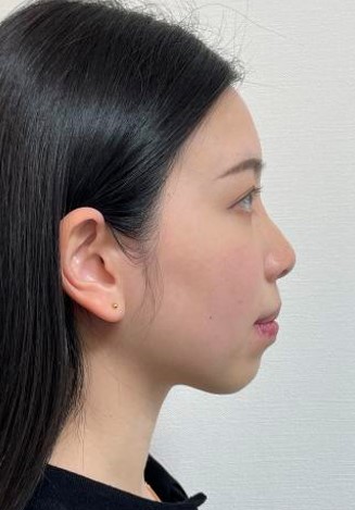 抜歯矯正による口元の改善