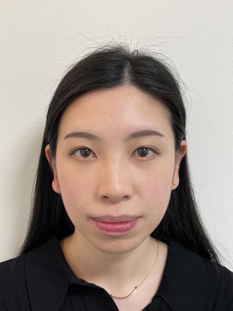 口元のインビザライン抜歯矯正