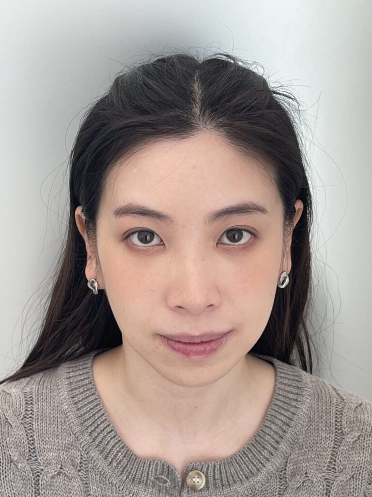 口元のインビザライン抜歯矯正