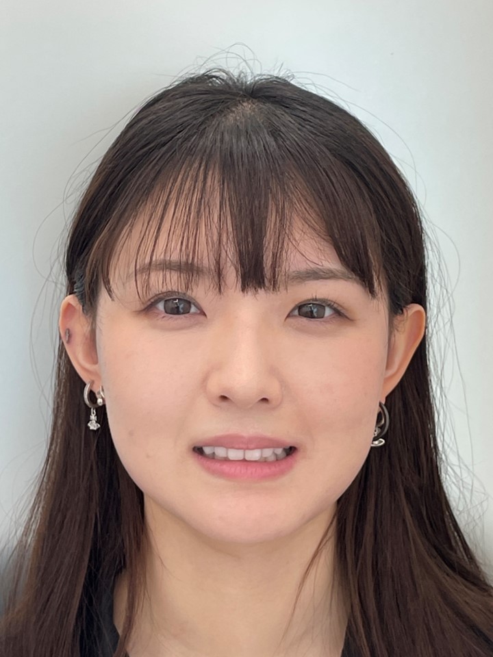 非抜歯矯正で口元の形とスマイルラインの改善