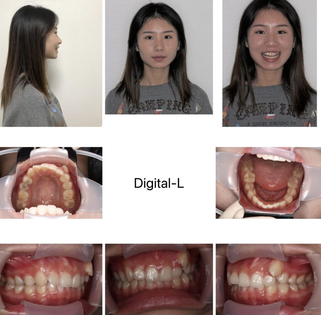 抜歯矯正：スマイルラインと八重歯の改善（17ヶ月）