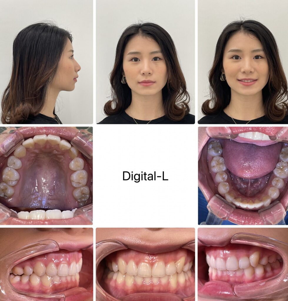 抜歯矯正：スマイルラインと八重歯の改善（17ヶ月）