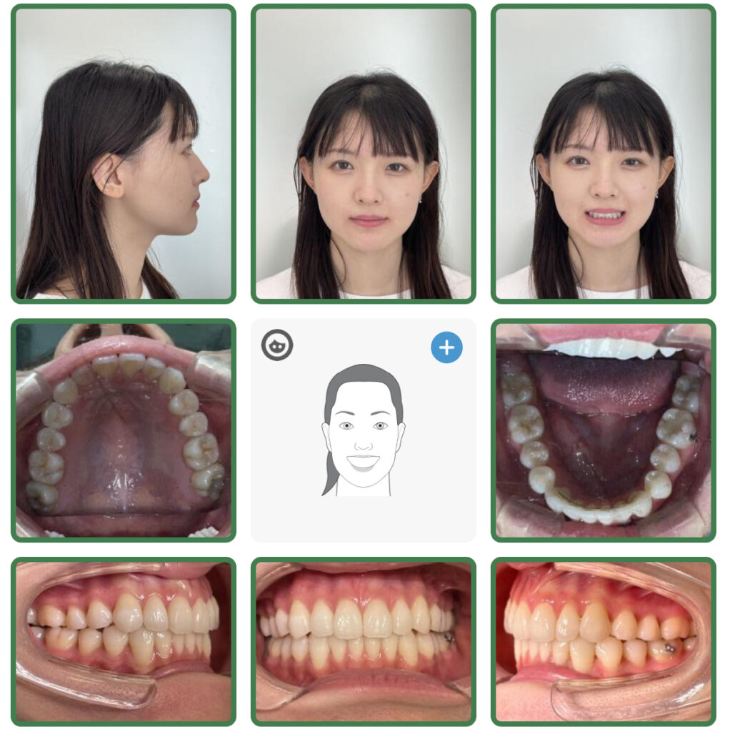 非抜歯矯正で口元の形とスマイルラインの改善
