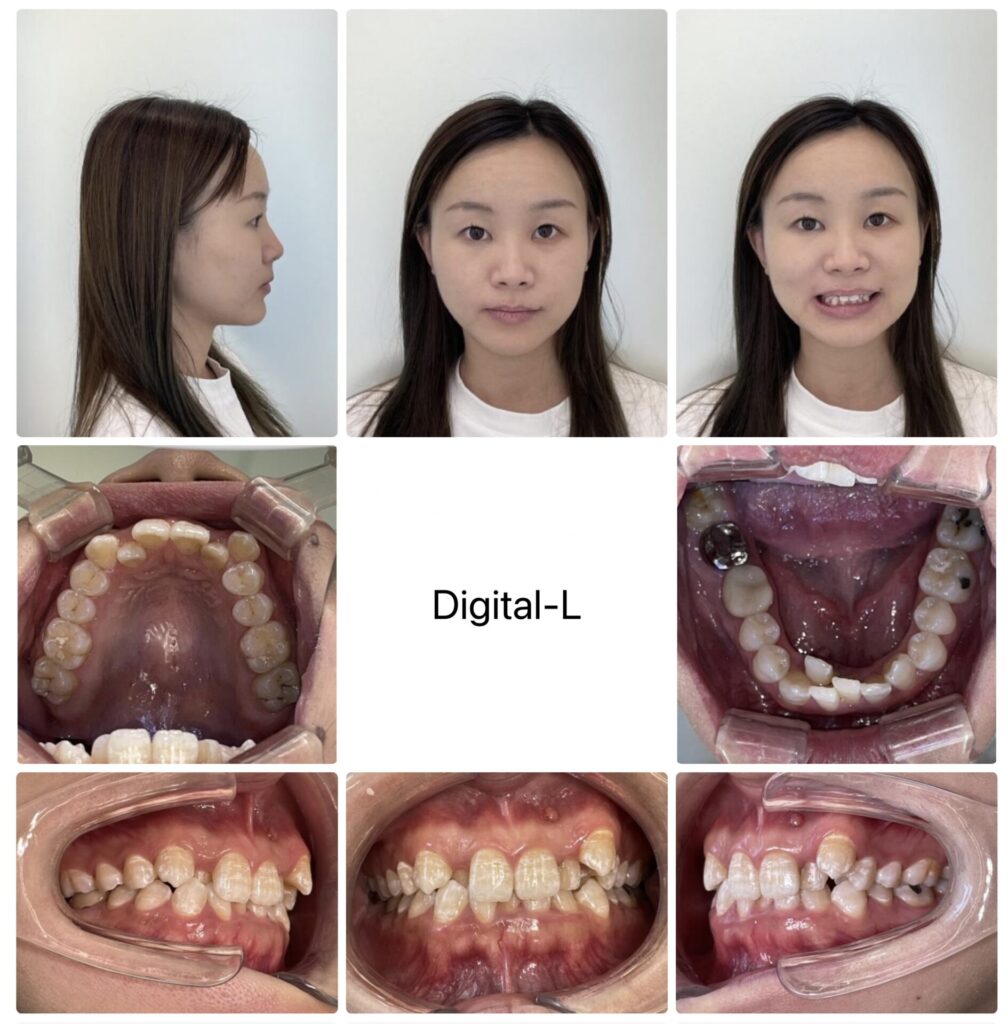 非抜歯矯正で口元の形とスマイルラインの改善