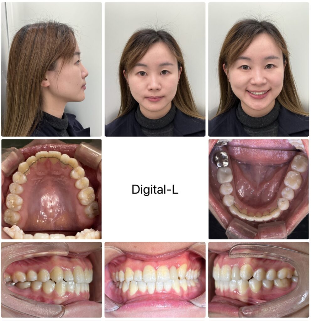 非抜歯矯正で口元の形とスマイルラインの改善