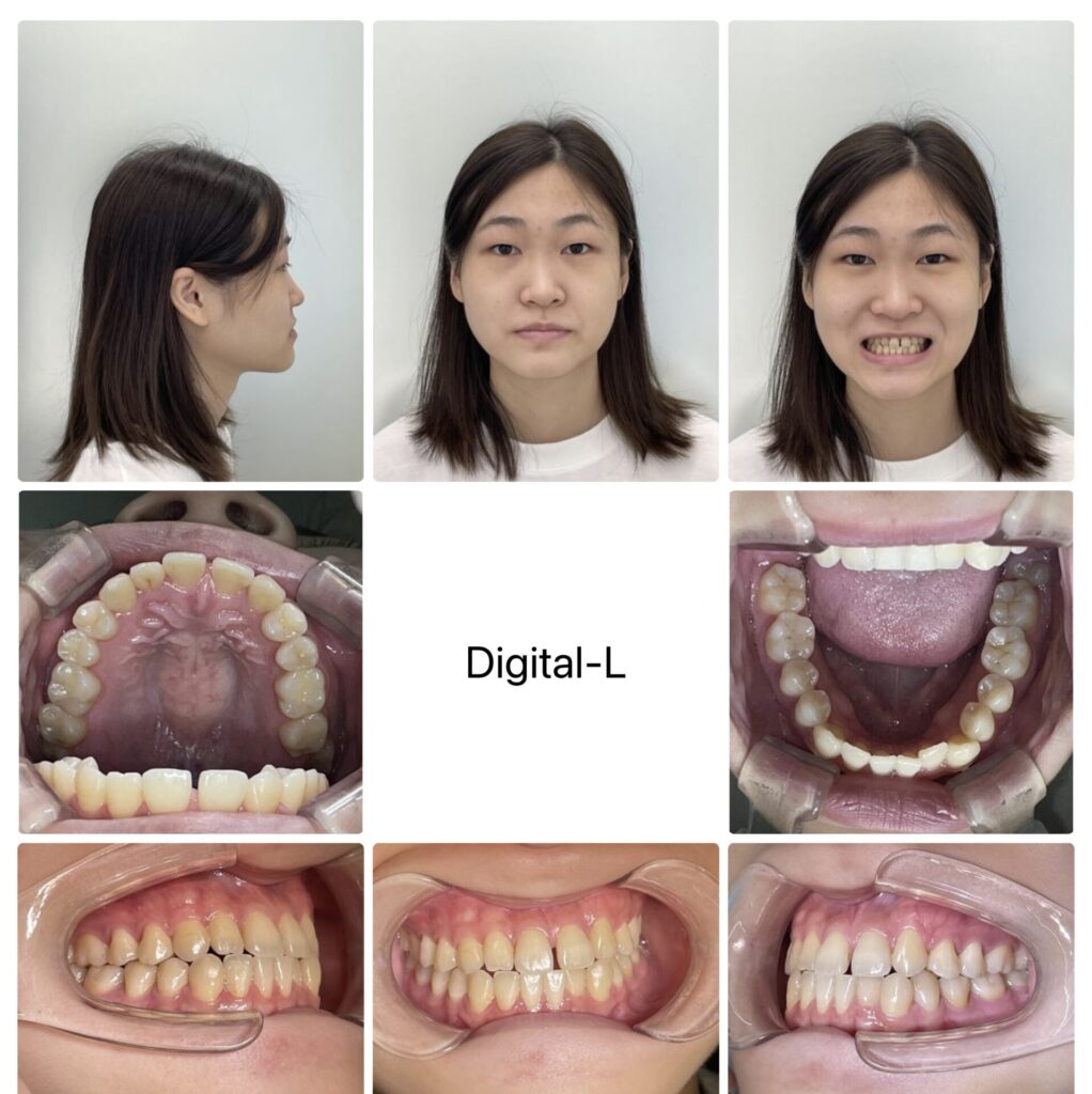 増歯矯正：口元の凹みの改善（17ヶ月）