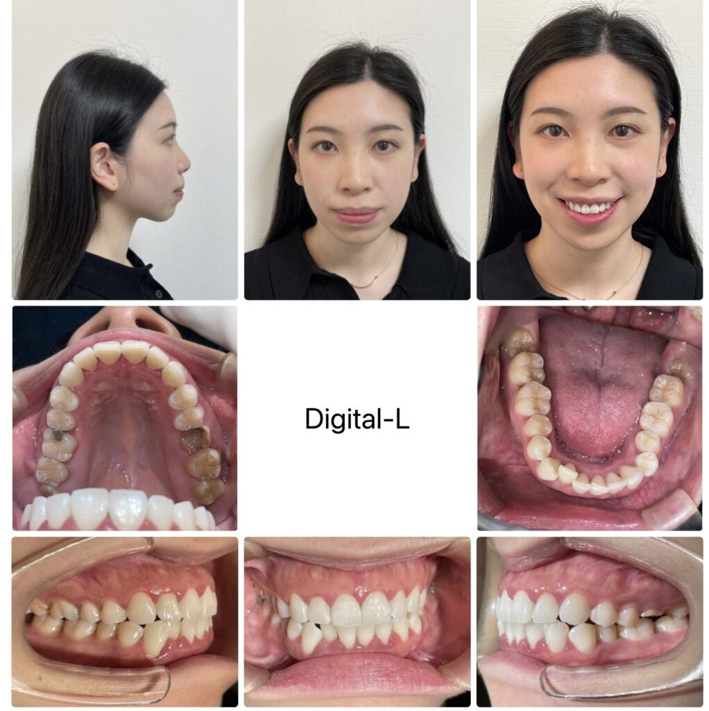 抜歯矯正で口元の形とスマイルラインの改善