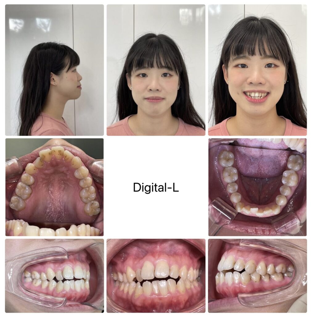 抜歯矯正：出っ歯、ガタガタと口元の改善（14ヶ月）