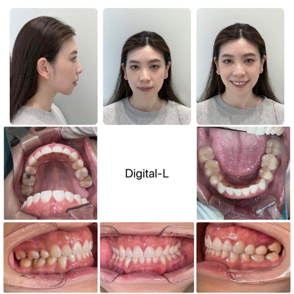 抜歯矯正で口元の形とスマイルラインの改善