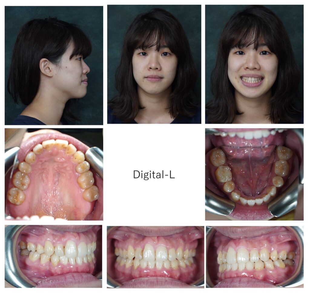 抜歯矯正：出っ歯、ガタガタと口元の改善（14ヶ月）